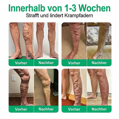 Healrize® VeinEase Mikronadel-Technologie⚡Spürbare Wirkung in Tagen – nachhaltige Verbesserung
