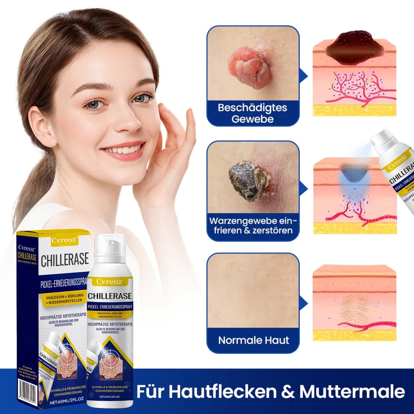 Cvreoz® ChillErase Pickel-Erneuerungsspray