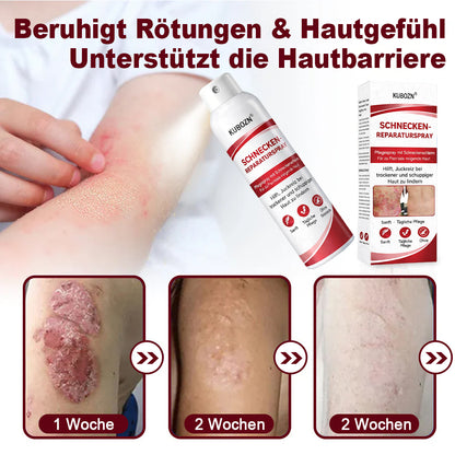 KUBOZN® Schneckenspray zur Behandlung von juckender, schuppiger Psoriasis-Haut