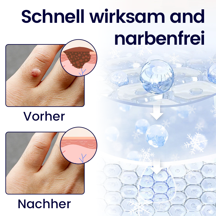 ❄️ Cvreoz® WartErase Cryo-Freeze Spray — Schnelle Entfernung von Warzen & Hautanhängseln💥
