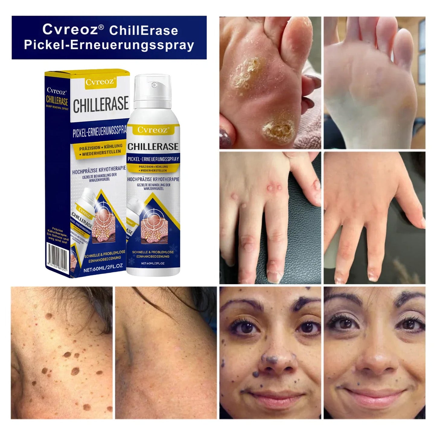 Cvreoz® ChillErase Pickel-Erneuerungsspray