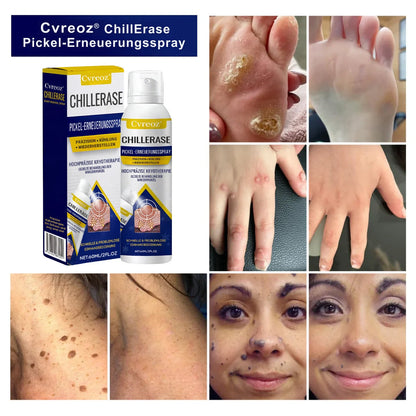 Cvreoz® ChillErase Pickel-Erneuerungsspray
