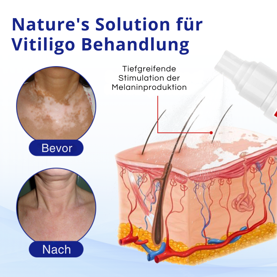 KUBOZN® Vitiligo-Behandlungsspray – Sichtbare Ergebnisse in wenigen Wochen, 100 % natürlich und steroidfrei