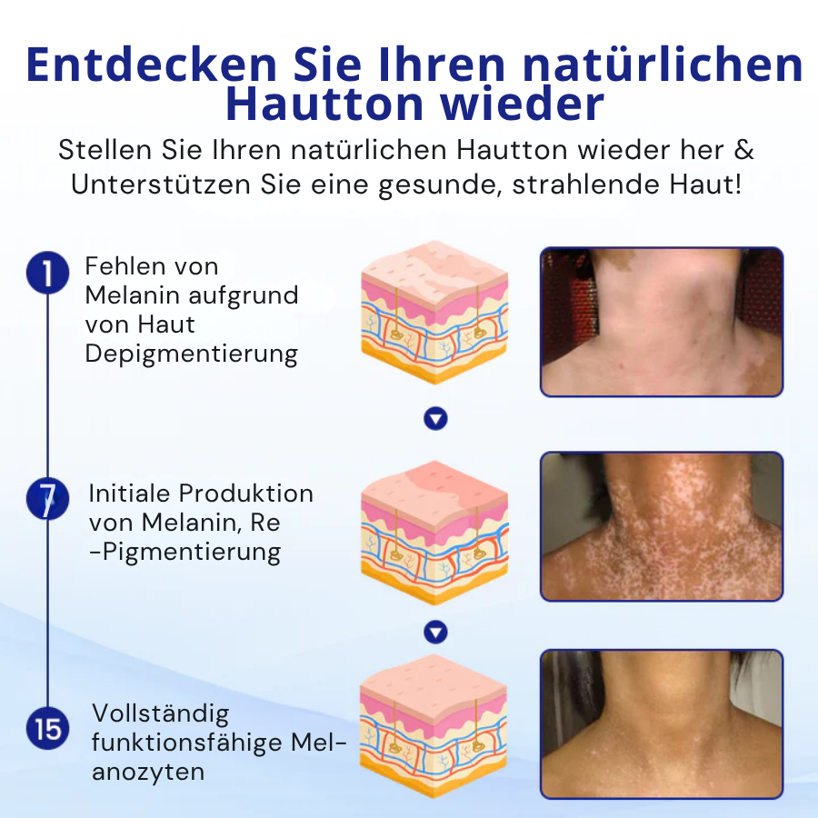 KUBOZN® Vitiligo-Behandlungsspray – Sichtbare Ergebnisse in wenigen Wochen, 100 % natürlich und steroidfrei